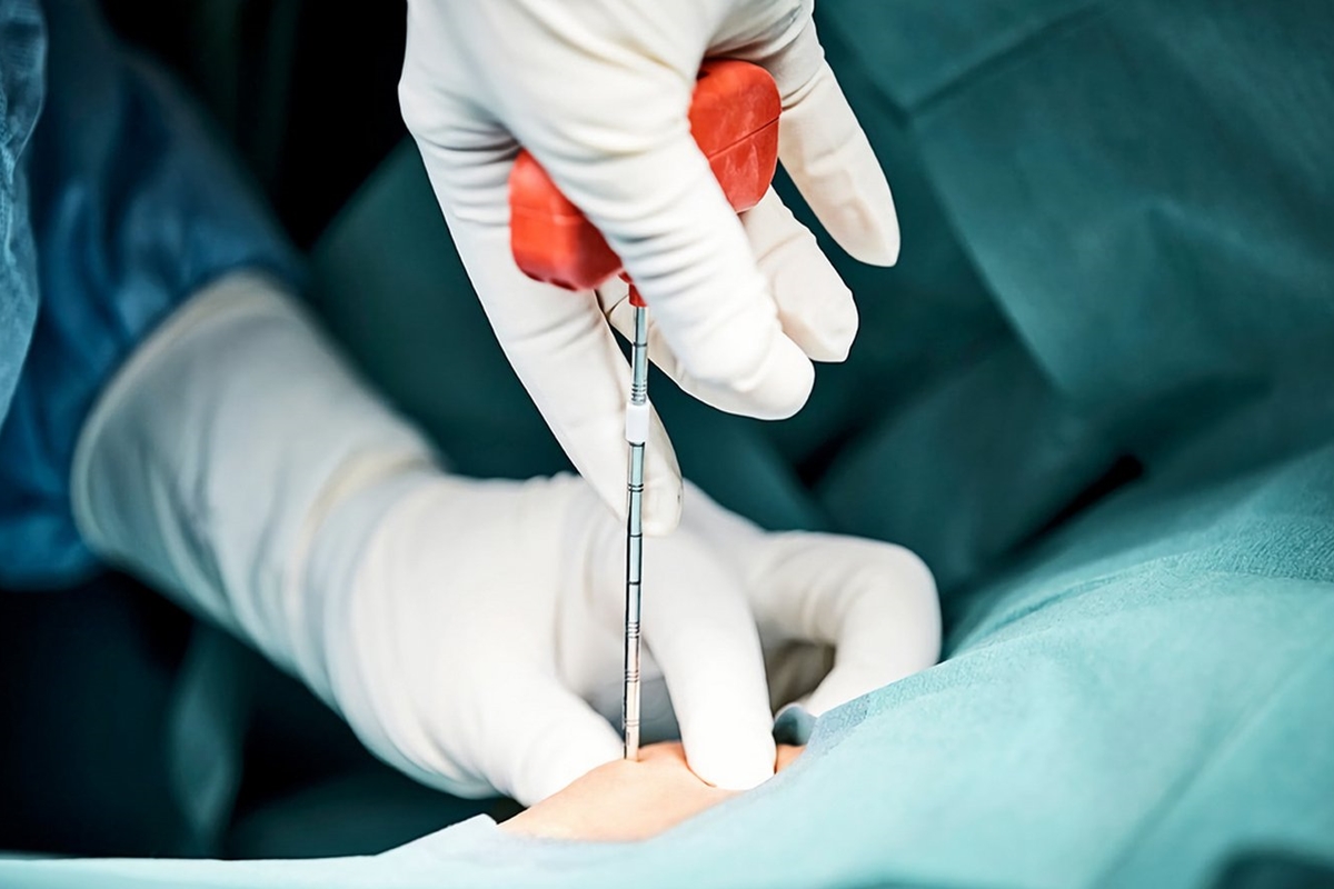 Bone Marrow Transplant: A Complete Guide to Treatment and Recovery