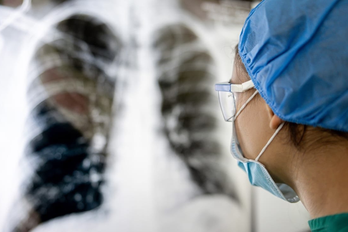 Lung Transplant: A Complete Guide to Treatment and Recovery